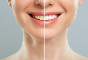 Teeth Cleaning and Teeth Whitening